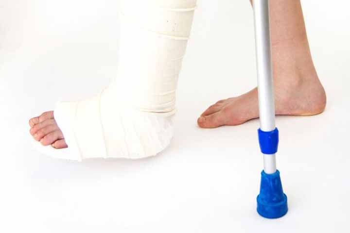 Leg with cast and crutches